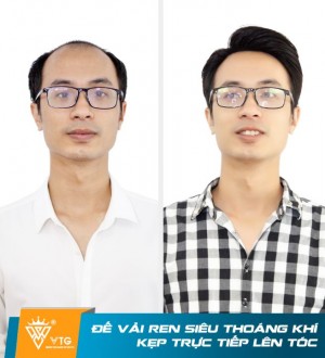 Tóc Giả Nam Mái Hói Màng Đôi - VTG D16